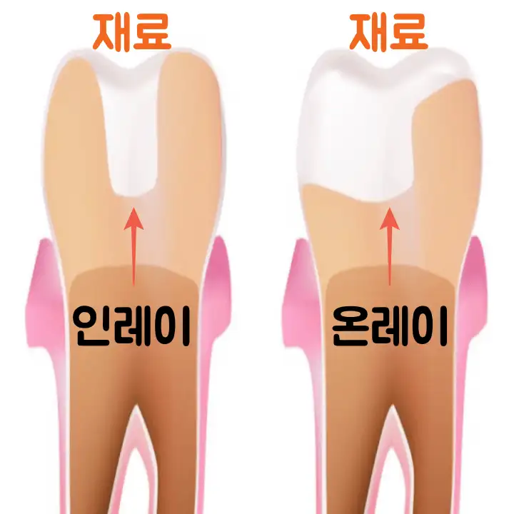 인레이-온레이-재료-씌우는-위치