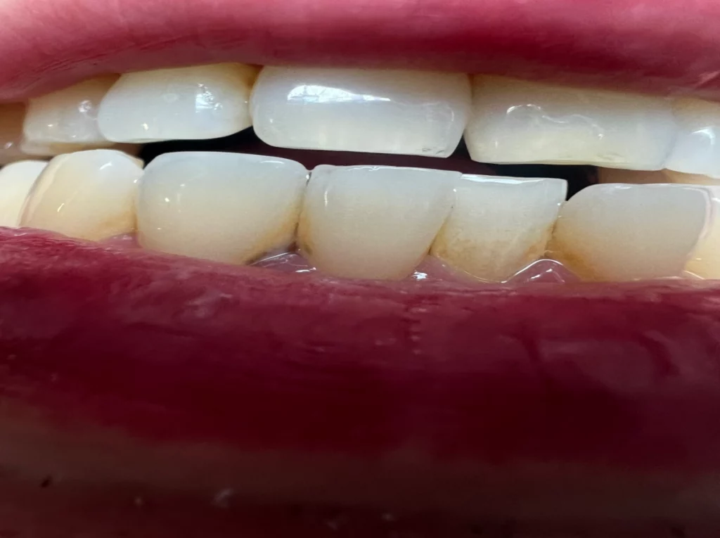 치석제거-전-모습-사진