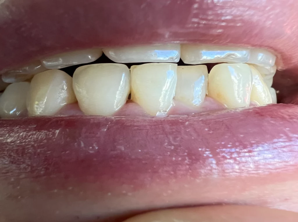 치석제거-후-모습