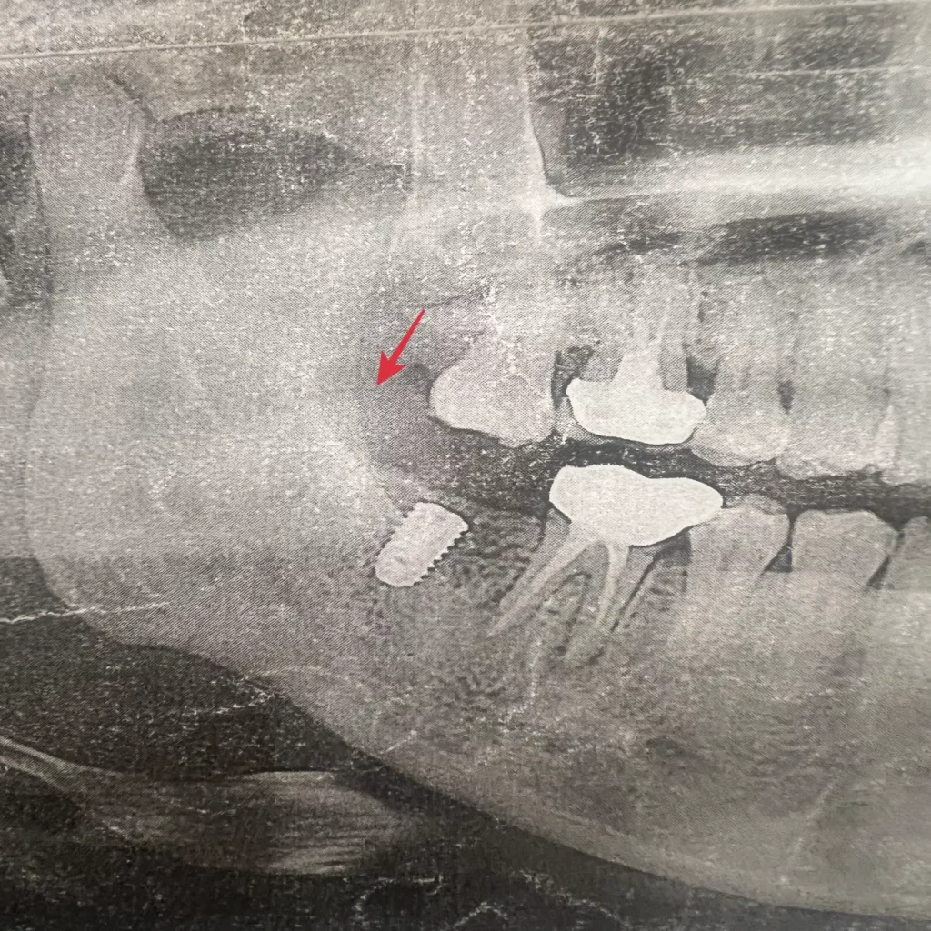 아래-어금니-치아-발치-후-위-치아가-내려온-모습