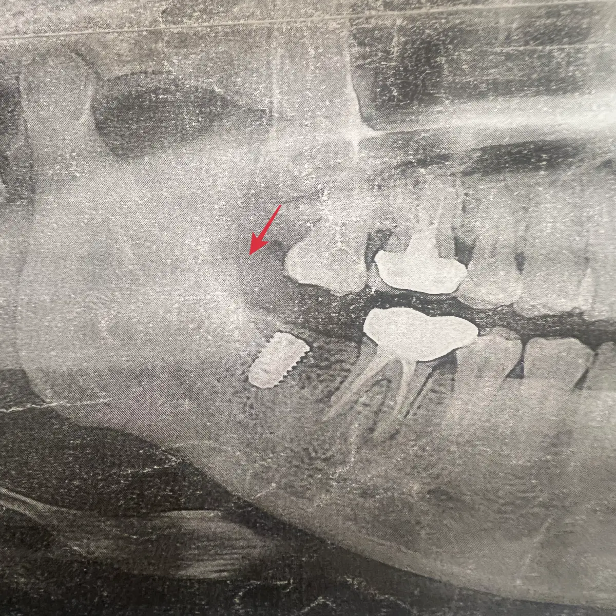 아래-어금니-치아-발치-후-위-치아가-내려온-모습