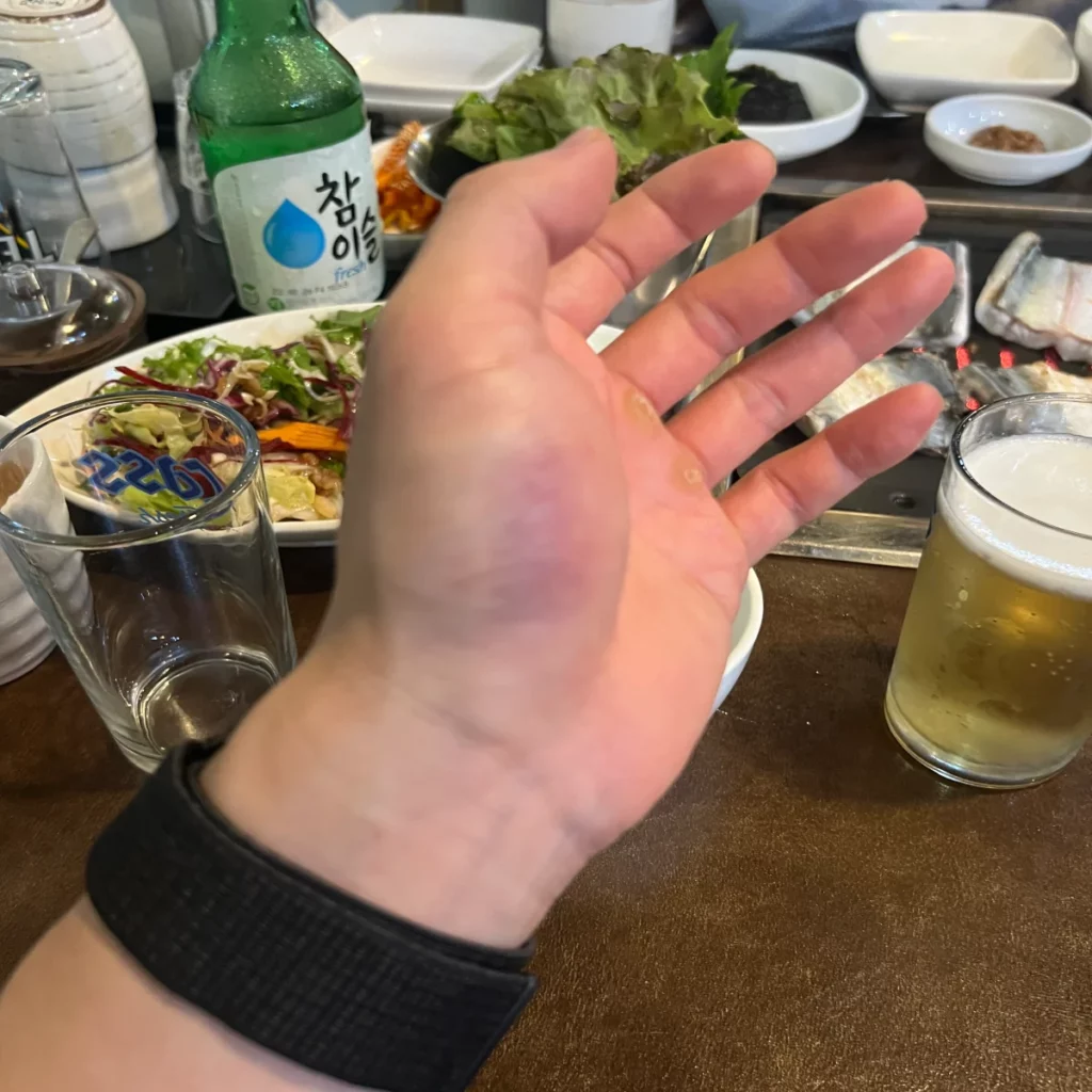 엄지손가락-뿌리-안쪽이-파랗게-멍든-모습