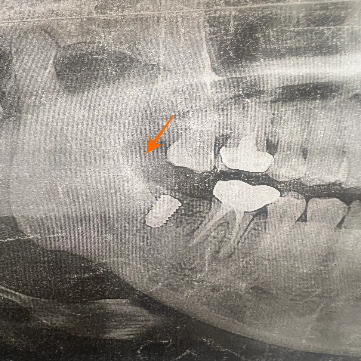 아래-어금니-발치-후-방치해서-위-어금니가-내려앉은-모습-사진