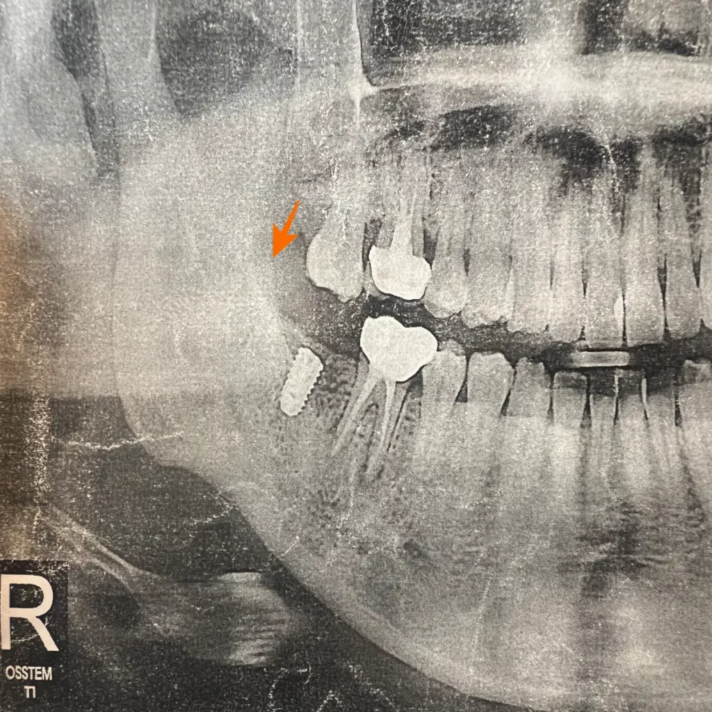 빠진-치아-위에-있는-치아가-내려앉은-모습