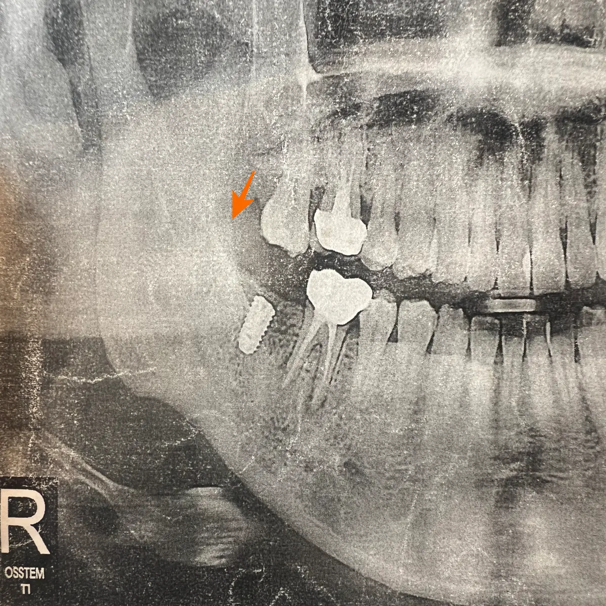 빠진-치아를-오래-방치해서-위-치아가-내려온-모습