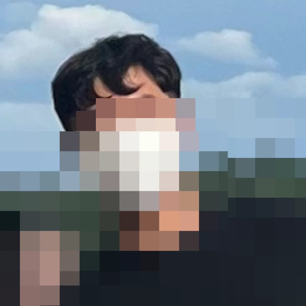 지루성-두피염-약물-치료-전-내-모습-사진