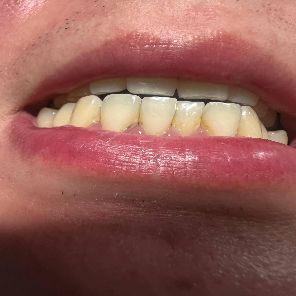 치아-사이-검은색-치석과-치아-표면에-치태가-쌓인-나의-치아-상태-사진