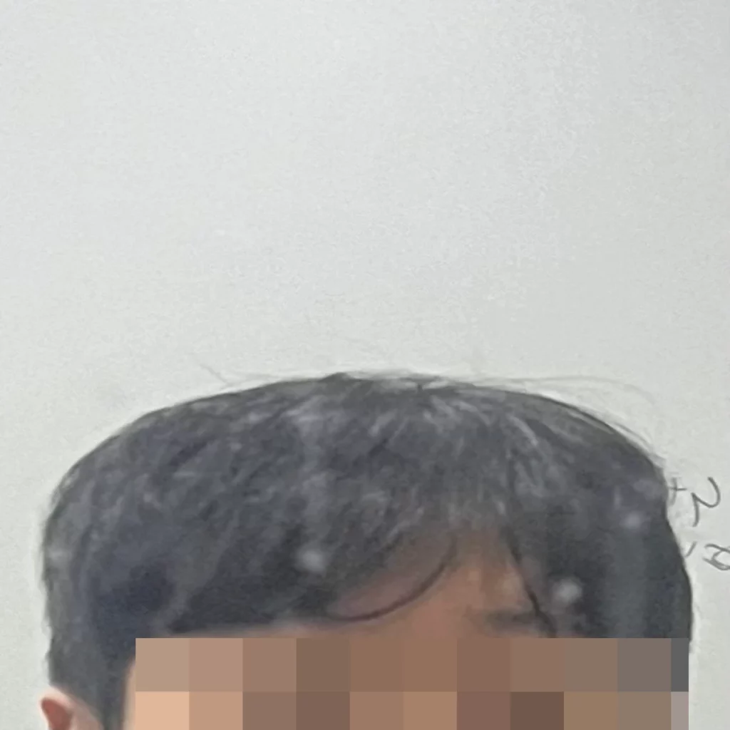 탈모약-복용-후-엠자라인-머리카락-상태