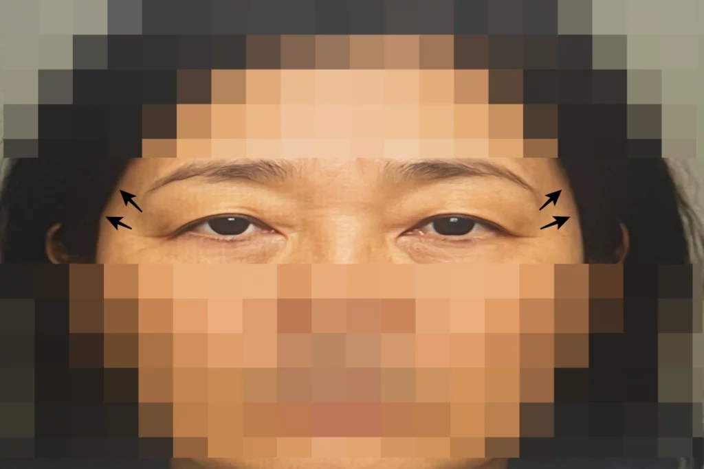 눈꼬리-리프팅-(실리프팅)-상담-시-찍은-사진