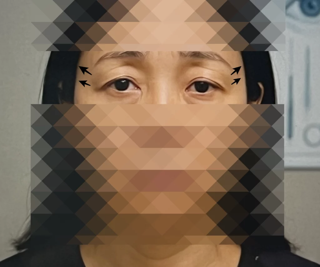 눈꼬리-올리는-수술-가격-상담-시-병원에서-찍은-사진