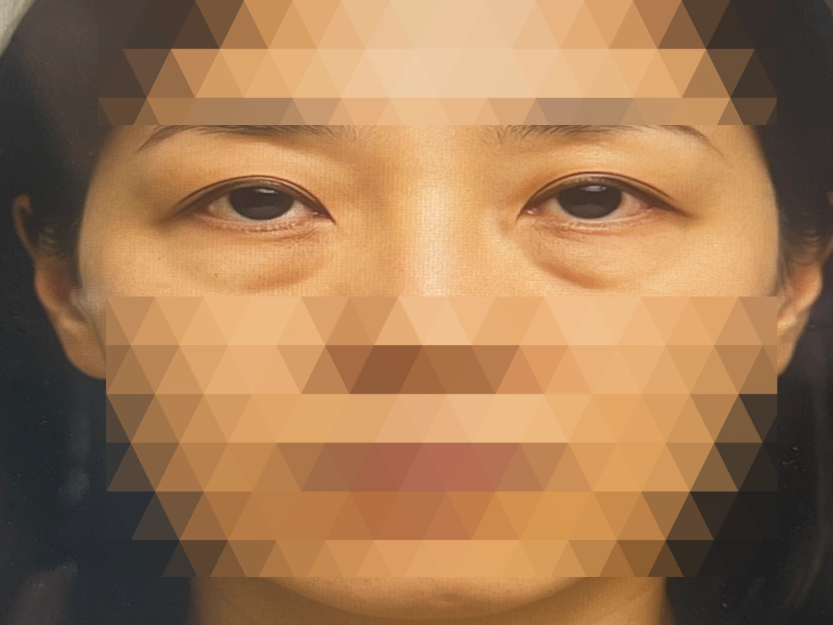 눈밑꺼짐으로-인한-필러-시술-지방재배치-병원-상담-사진