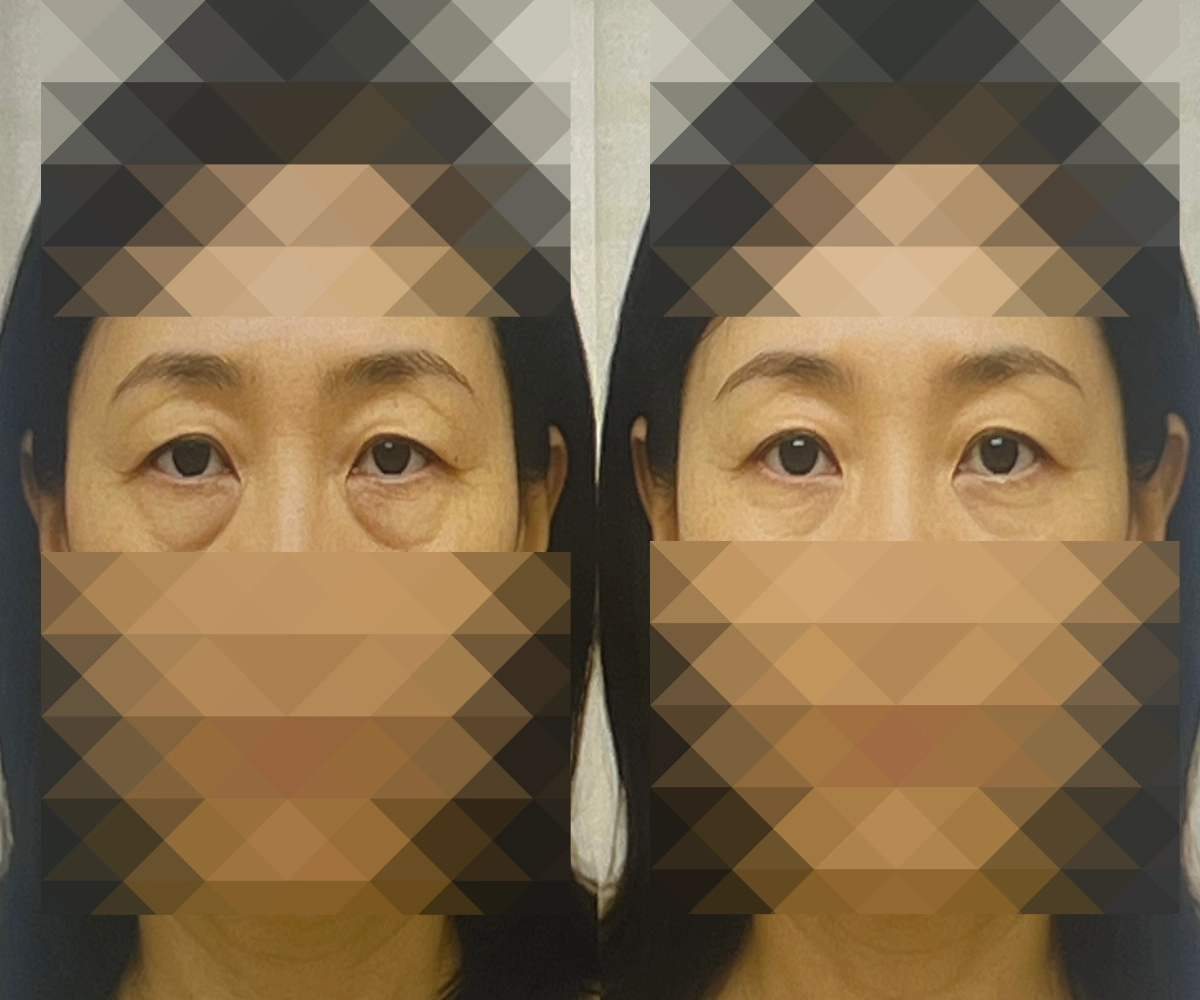 눈밑지방재배치-수술비용-상담-갔다가-찍은-전후사진-모습