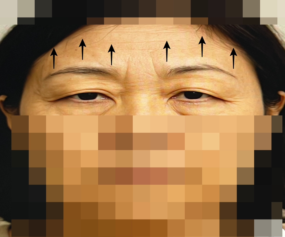 눈썹-실리프팅-상담-사진에서-보이는-눈처짐