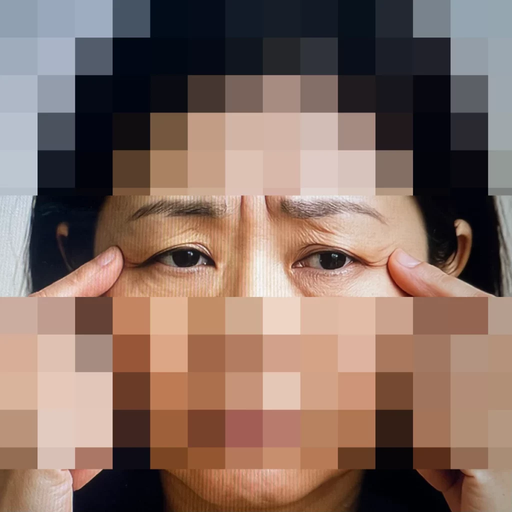 눈처짐이-심한-중년의-여성