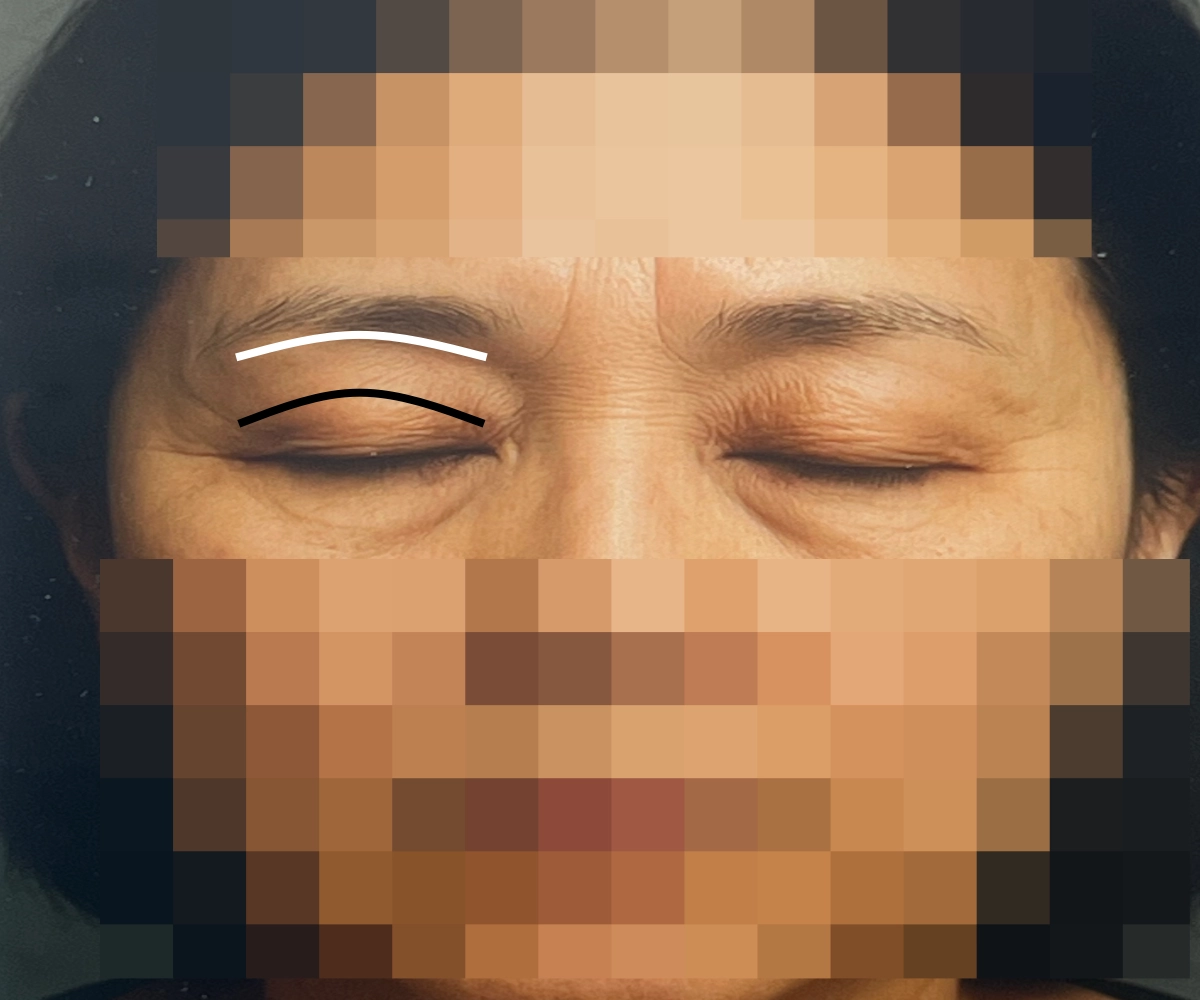 눈쳐짐-수술-절개-라인-표시-사진