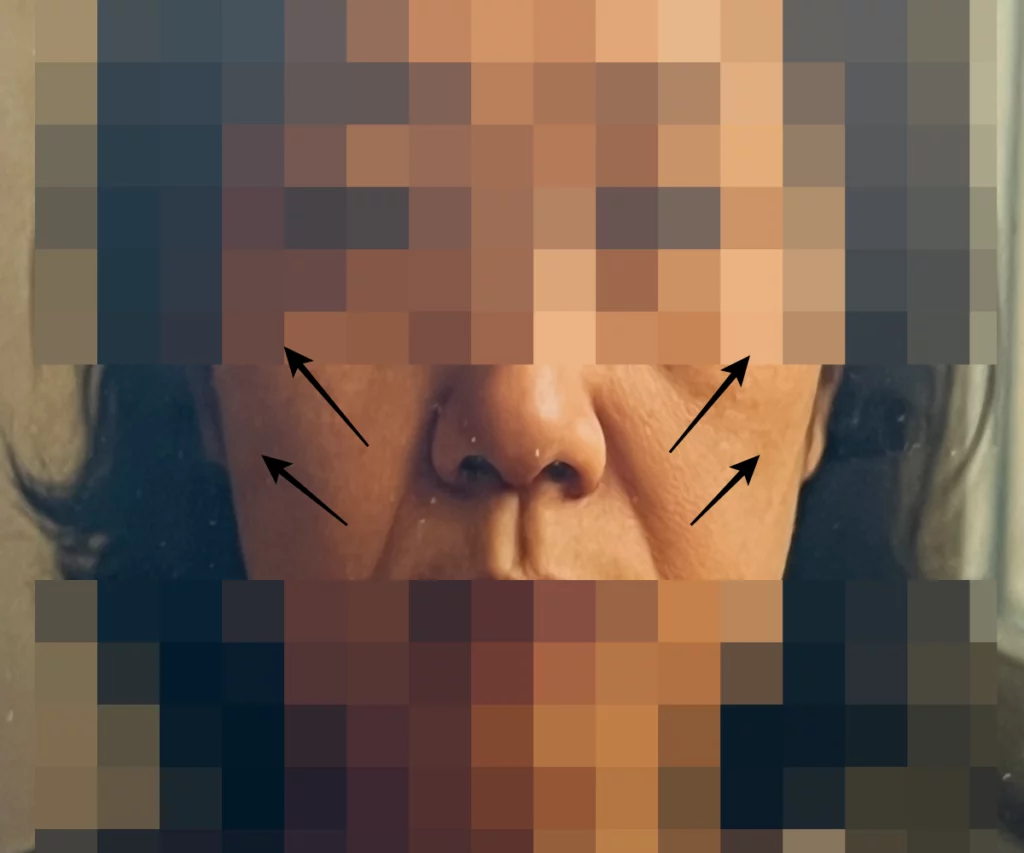 민트실리프팅-가격-통증-상담-시-찍었던-사진