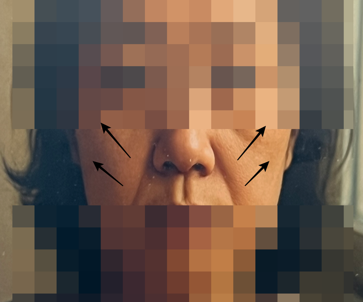 민트실리프팅-가격-통증-상담-시-찍었던-사진