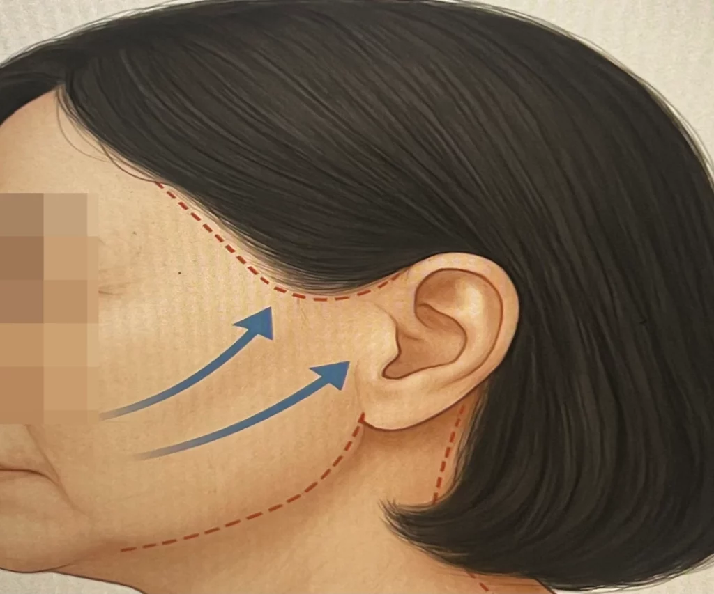 안면거상술-수술-방법-예시-사진