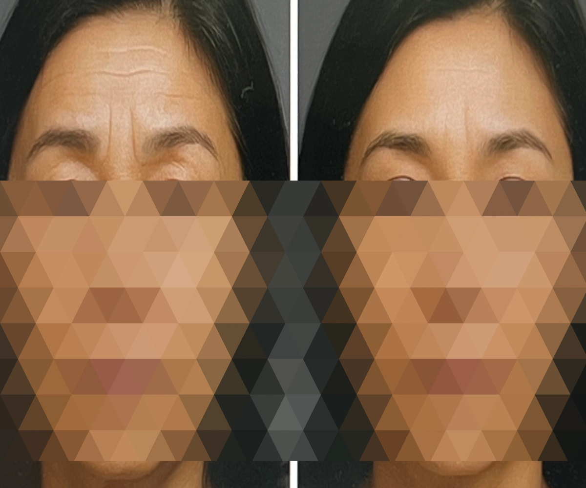 이마거상술-효과-전후-사진-모습-before-after-picture