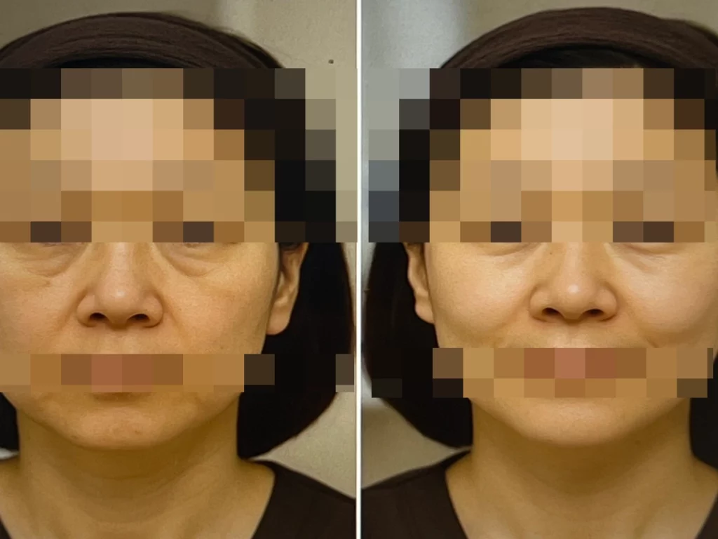 인모드-리프팅-fx-포마-효과-가격-상담-시-찍은-사진