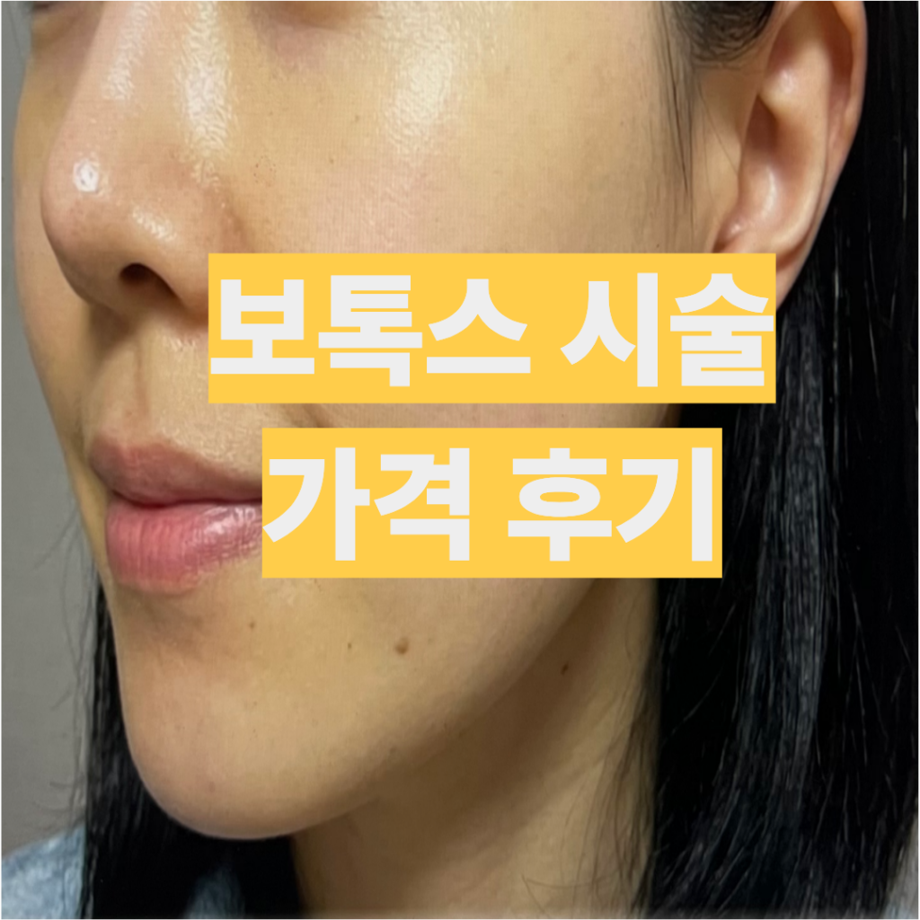 사각턱 침샘 승모근 종아리 보톡스 가격 후기 작성위해 찍은 셀카