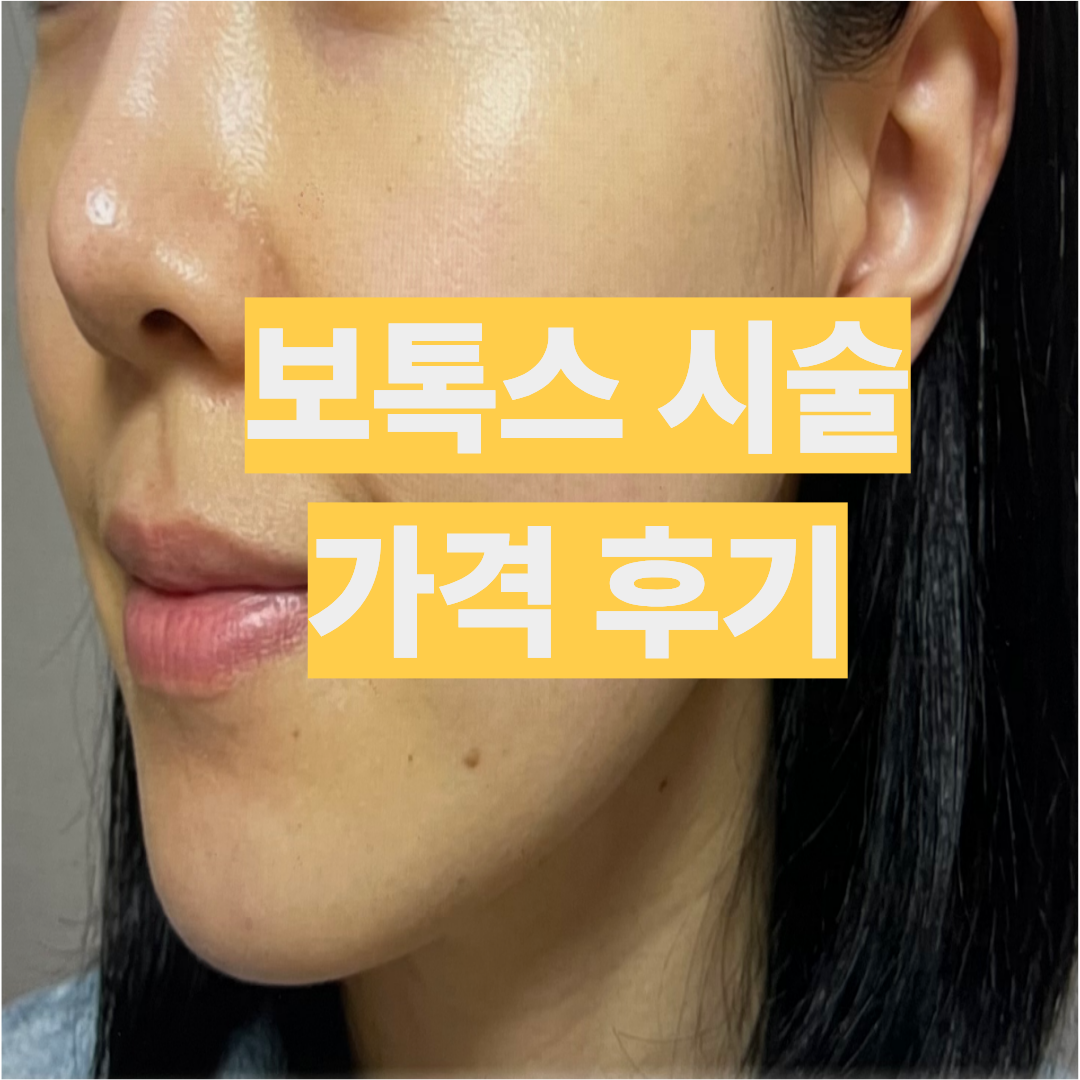 사각턱 침샘 승모근 종아리 보톡스 가격 후기 작성위해 찍은 셀카