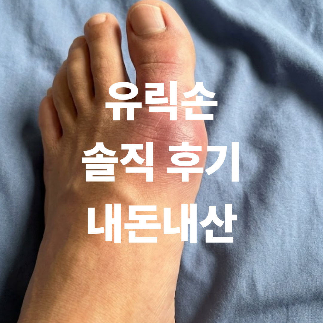내돈내산 유릭손 후기 작성하기 위해 찍은 나의 통풍 온 발 사진