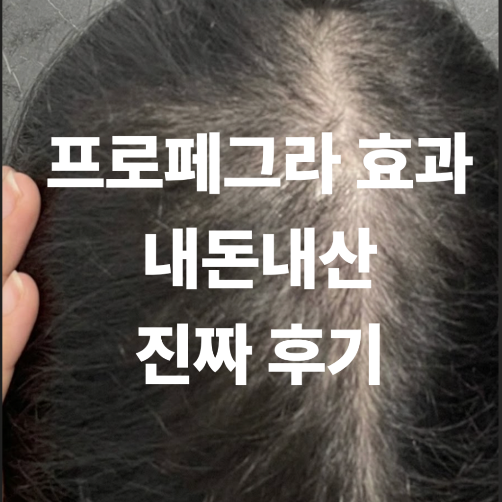 프로페그라 효과 보기 전 후기 작성을 위해 찍어둔 정수리 사진