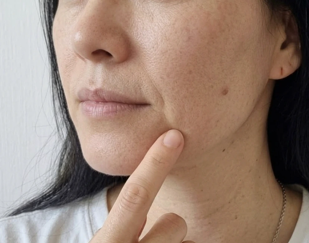 유네브 hydrosome 리본젤리 후기를 작성하기 위해 찍은 나의 팔자주름 사진